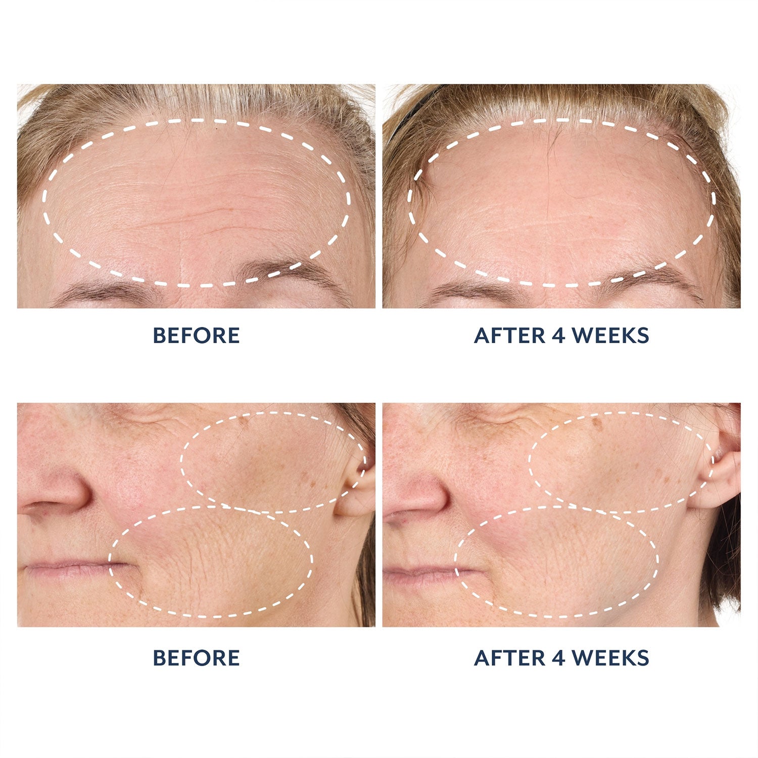 Before and after comparison showing visibly reduced wrinkles on forehead and cheeks after 4 weeks of using Black Tulip Regenerative Brightening Serum.